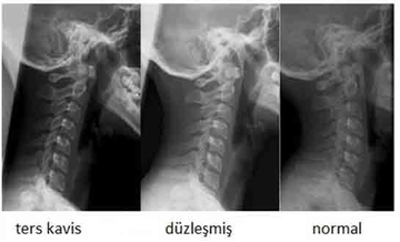 Boyun Kemiği Düzleşmesi Belirtileri ve Tedavisi