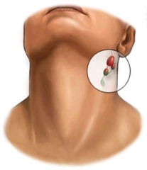 Boyunda Kitle Belirtileri ve Tedavisi